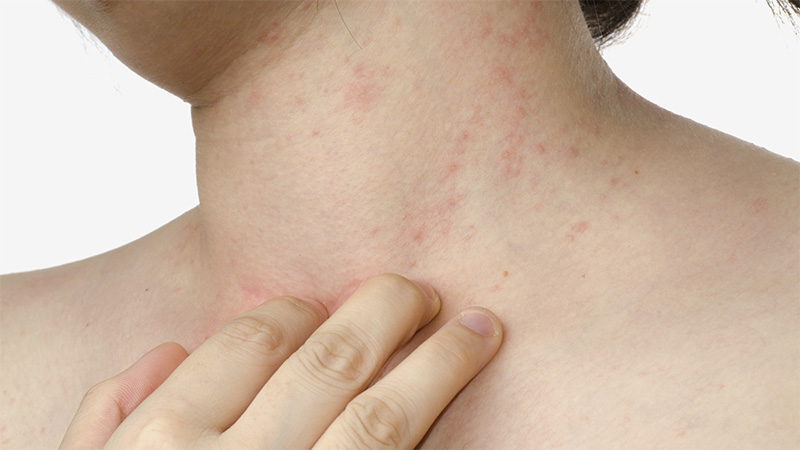 Може ли постојати алергија на шаргарепу, како се манифестује и како се лечи?