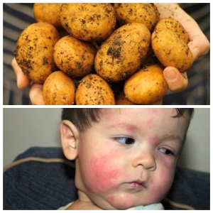 Comment l'allergie aux pommes de terre se manifeste-t-elle chez les enfants et les adultes