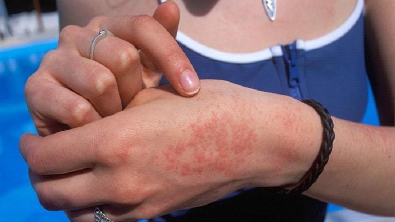 Como a alergia à batata se manifesta em crianças e adultos