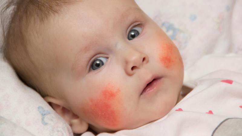 Bebeklerin karabuğdaya alerjisi var mı