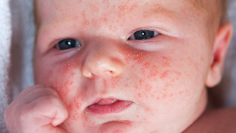 Bebeklerin karabuğdaya alerjisi var mı
