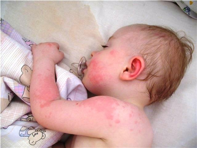 Existe alergia à couve-flor em bebês?